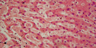 tuberkuloos, abstraktne kujutis